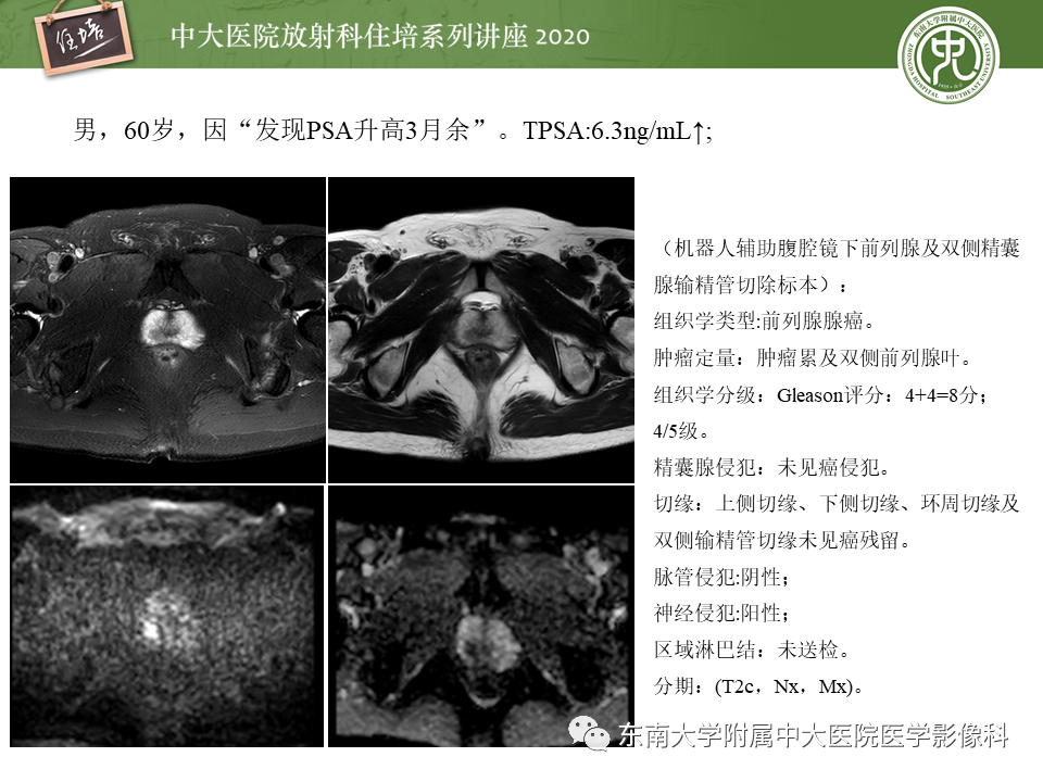 【PPT】MRI在前列腺癌TNM分期中的应用