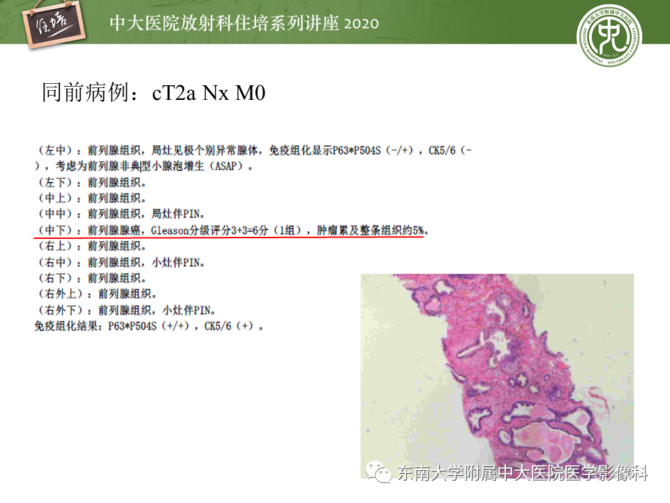 【PPT】MRI在前列腺癌TNM分期中的应用