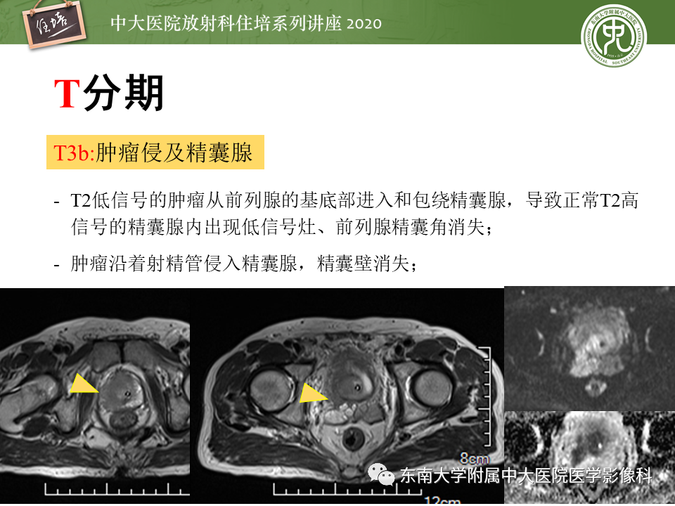 【PPT】MRI在前列腺癌TNM分期中的应用