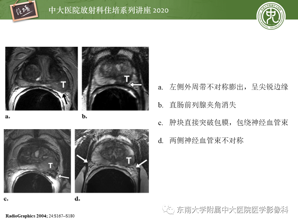 【PPT】MRI在前列腺癌TNM分期中的应用