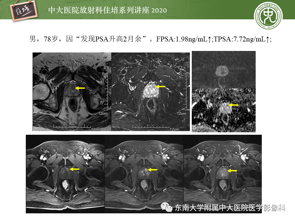 【PPT】MRI在前列腺癌TNM分期中的应用