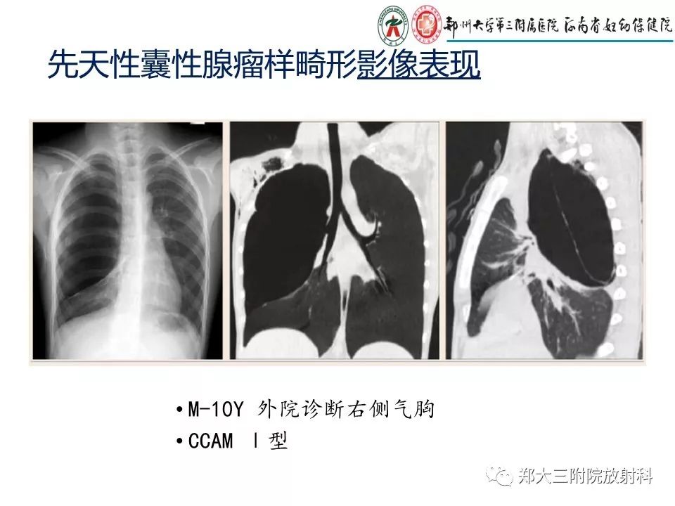 【PPT】先天性肺囊性腺瘤样畸形的影像诊断