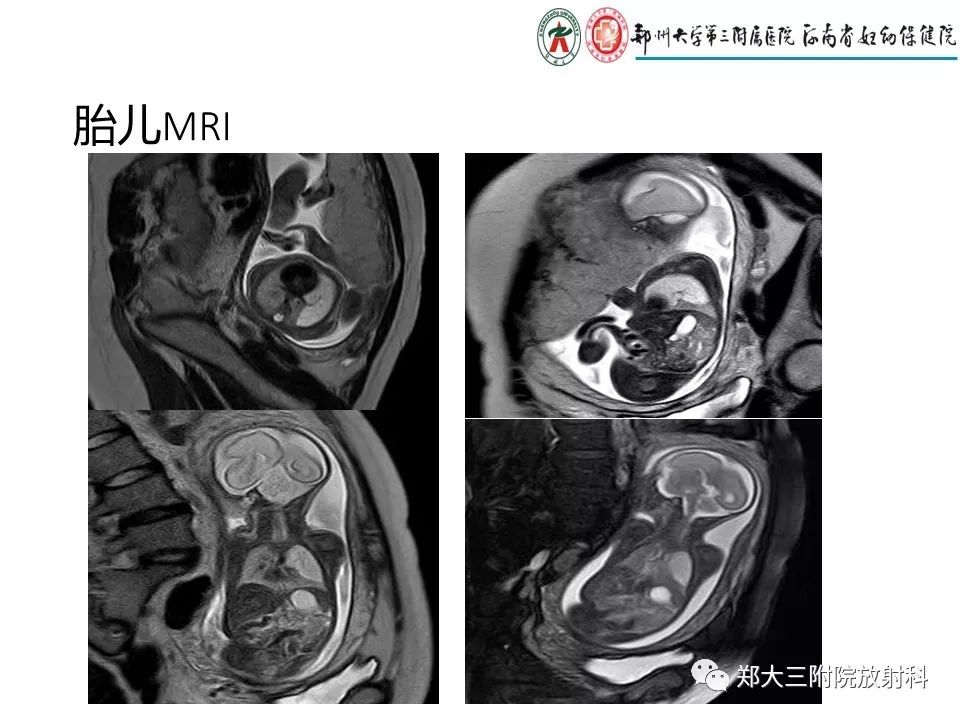 【PPT】先天性肺囊性腺瘤样畸形的影像诊断