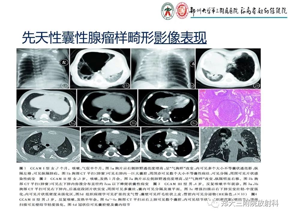 【PPT】先天性肺囊性腺瘤样畸形的影像诊断