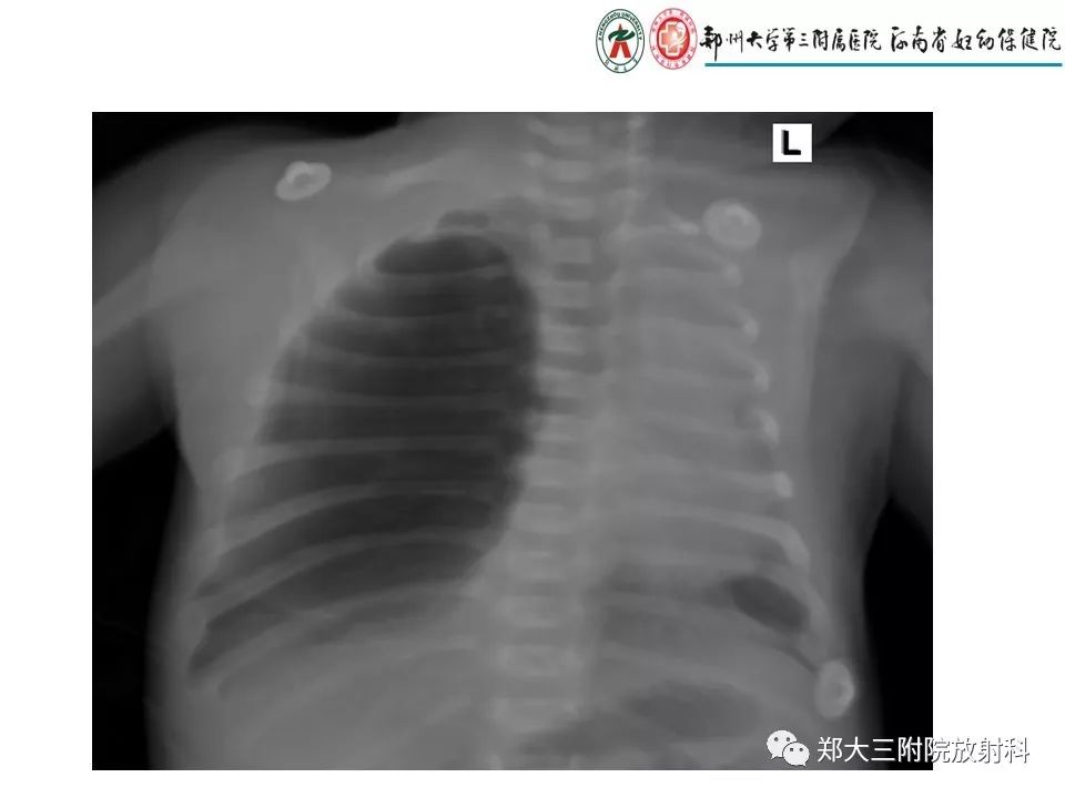 【PPT】先天性肺囊性腺瘤样畸形的影像诊断