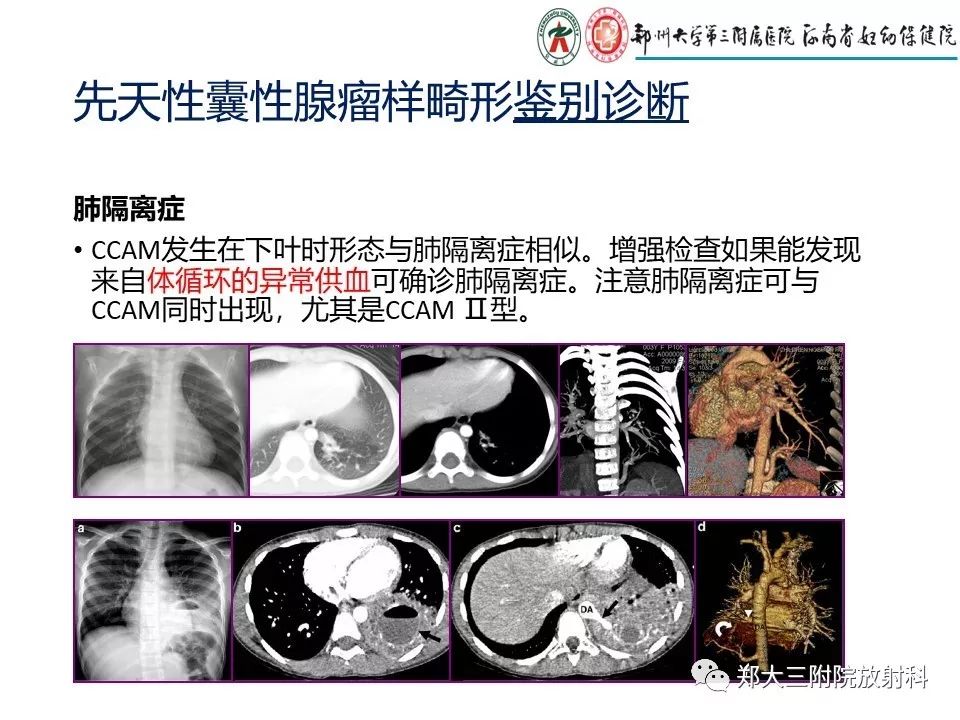 【PPT】先天性肺囊性腺瘤样畸形的影像诊断