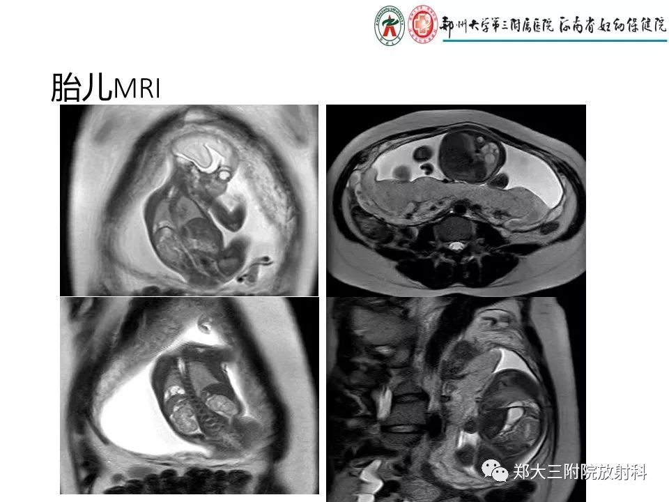 【PPT】先天性肺囊性腺瘤样畸形的影像诊断