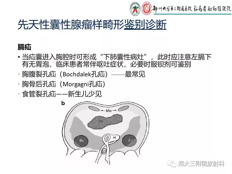 【PPT】先天性肺囊性腺瘤样畸形的影像诊断