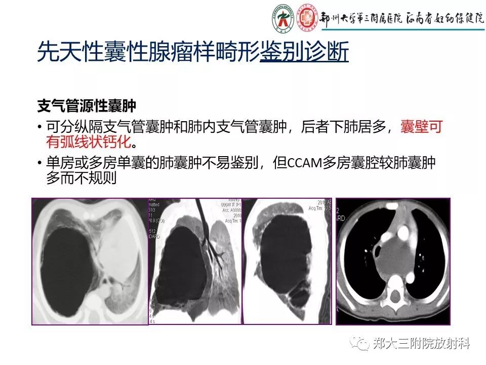 【PPT】先天性肺囊性腺瘤样畸形的影像诊断