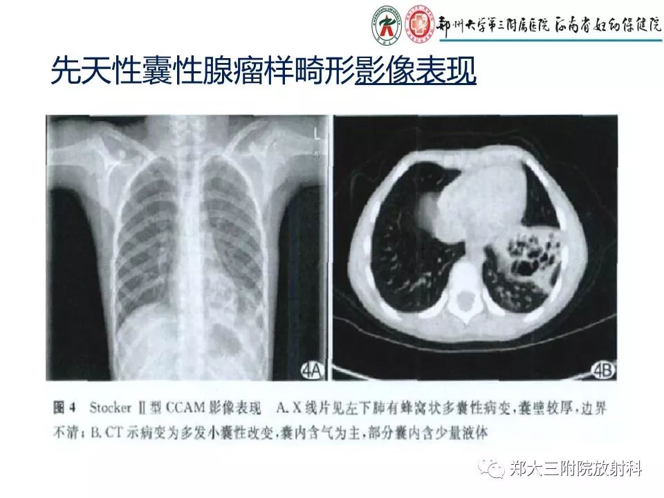 【PPT】先天性肺囊性腺瘤样畸形的影像诊断