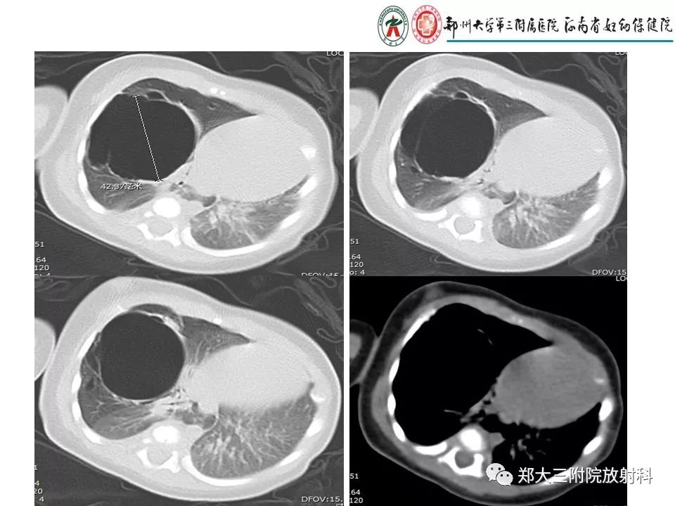 【PPT】先天性肺囊性腺瘤样畸形的影像诊断