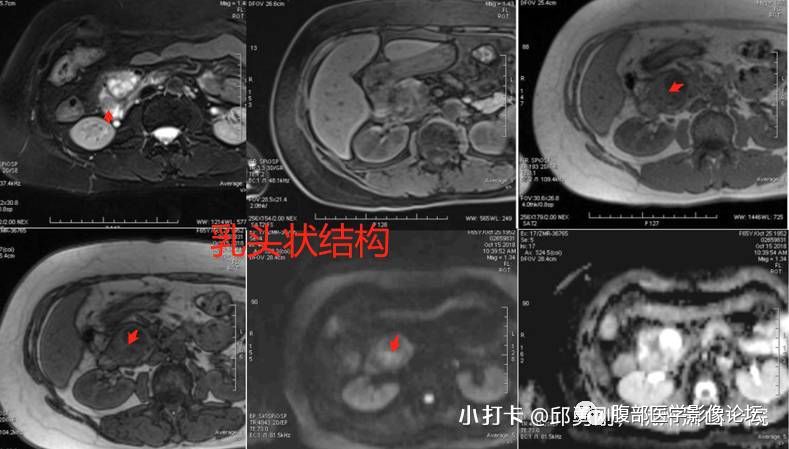 【病例】胰腺导管内乳头状粘液性肿瘤1例CT及MR影像 【病例】胰腺导管内乳头状粘液性肿瘤1例CT及MR影像