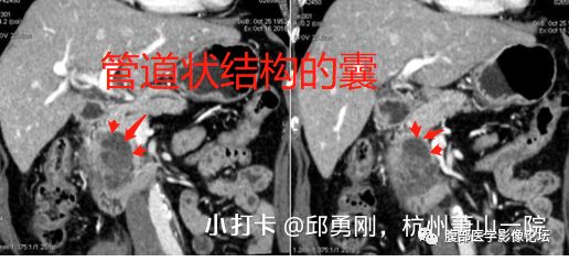 【病例】胰腺导管内乳头状粘液性肿瘤1例CT及MR影像 【病例】胰腺导管内乳头状粘液性肿瘤1例CT及MR影像