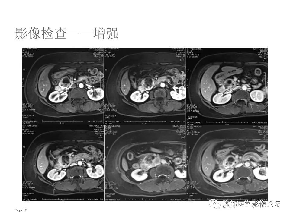 【病例】胰腺导管内乳头状粘液性肿瘤1例CT及MR影像
