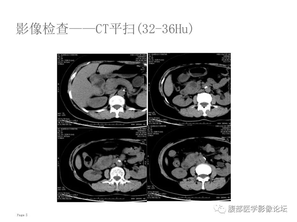 【病例】胰腺导管内乳头状粘液性肿瘤1例CT及MR影像