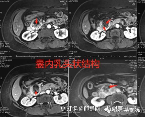 【病例】胰腺导管内乳头状粘液性肿瘤1例CT及MR影像 【病例】胰腺导管内乳头状粘液性肿瘤1例CT及MR影像