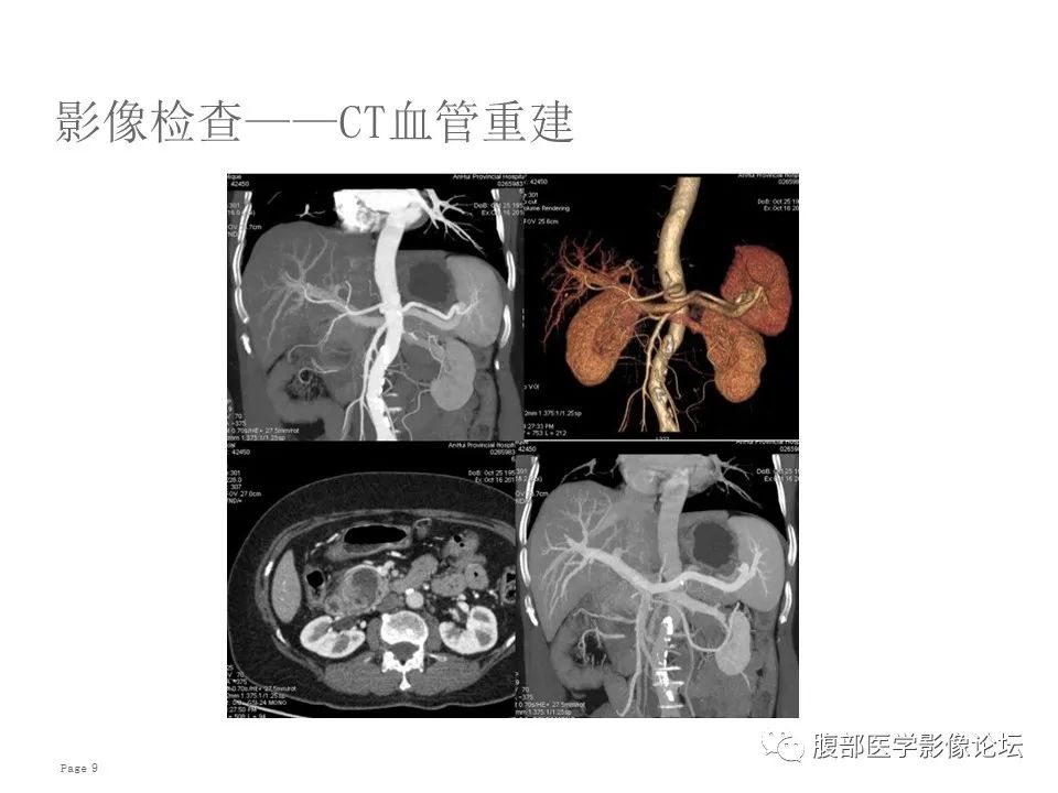 【病例】胰腺导管内乳头状粘液性肿瘤1例CT及MR影像