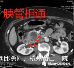 【病例】胰腺导管内乳头状粘液性肿瘤1例CT及MR影像 【病例】胰腺导管内乳头状粘液性肿瘤1例CT及MR影像