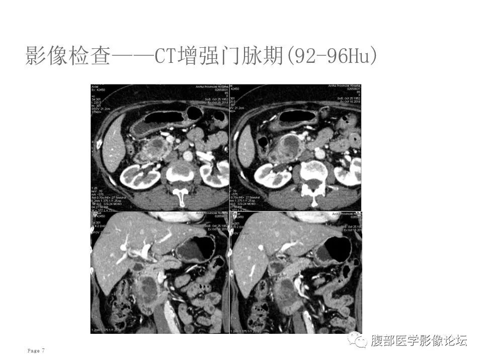 【病例】胰腺导管内乳头状粘液性肿瘤1例CT及MR影像