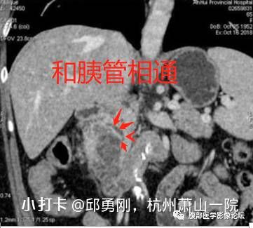 【病例】胰腺导管内乳头状粘液性肿瘤1例CT及MR影像
