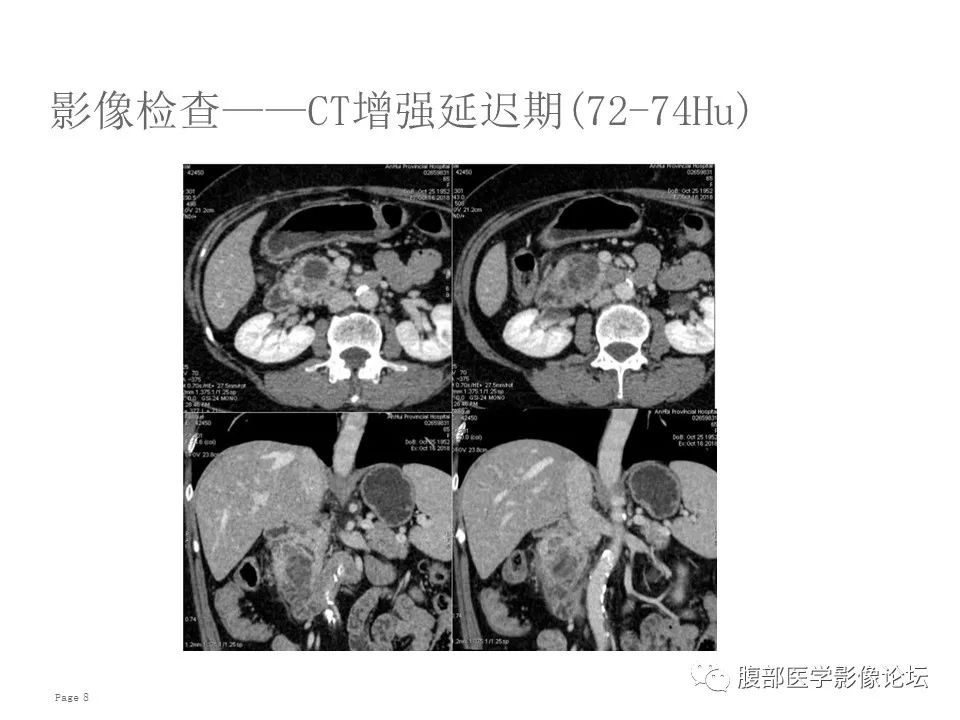 【病例】胰腺导管内乳头状粘液性肿瘤1例CT及MR影像
