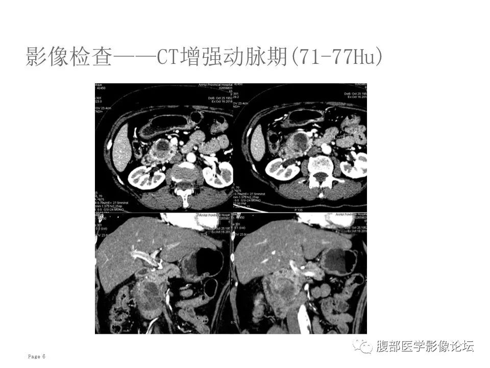 【病例】胰腺导管内乳头状粘液性肿瘤1例CT及MR影像