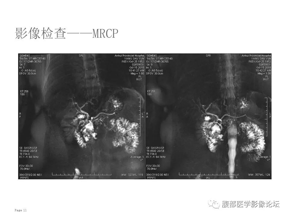 【病例】胰腺导管内乳头状粘液性肿瘤1例CT及MR影像