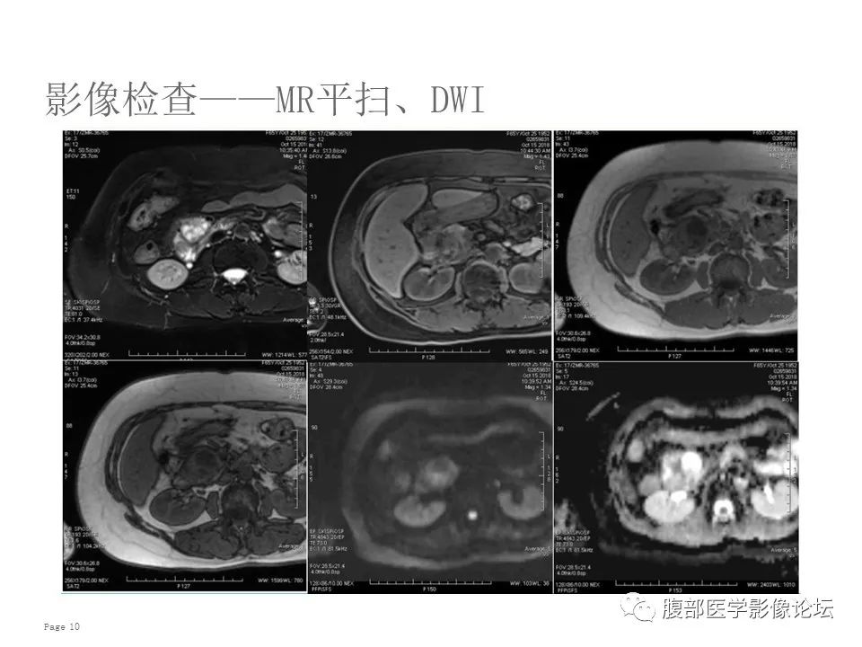 【病例】胰腺导管内乳头状粘液性肿瘤1例CT及MR影像