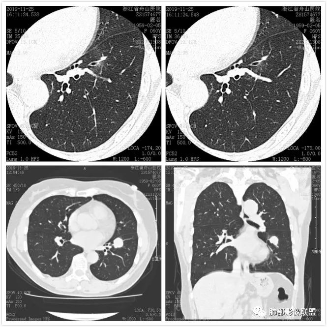 【病例】肺腺癌1例CT影像讨论