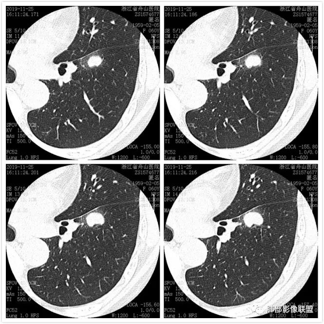 【病例】肺腺癌1例CT影像讨论