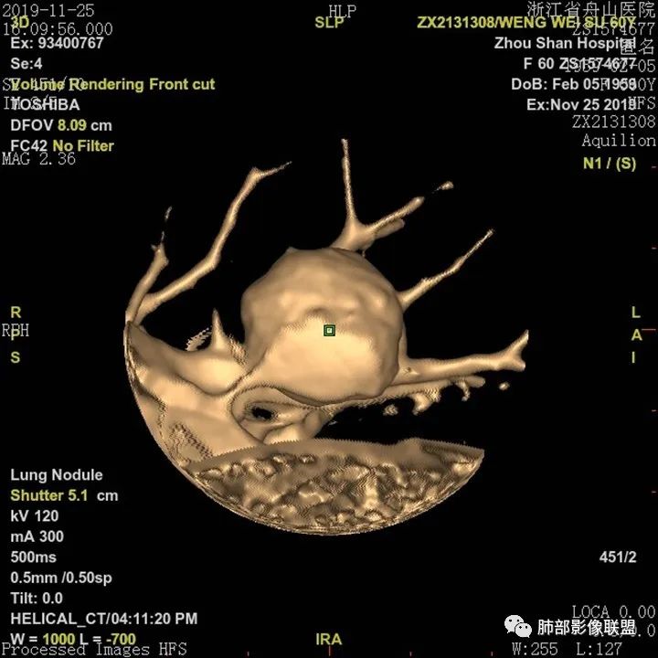 【病例】肺腺癌1例CT影像讨论