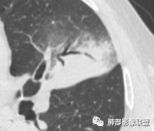【病例】让人琢磨不透的肺肿块—肺癌1例CT影像