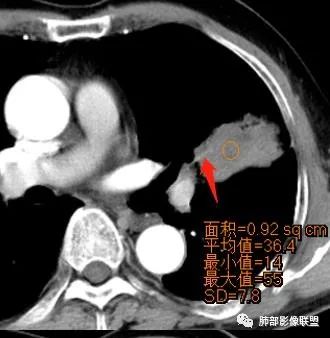 【病例】让人琢磨不透的肺肿块—肺癌1例CT影像