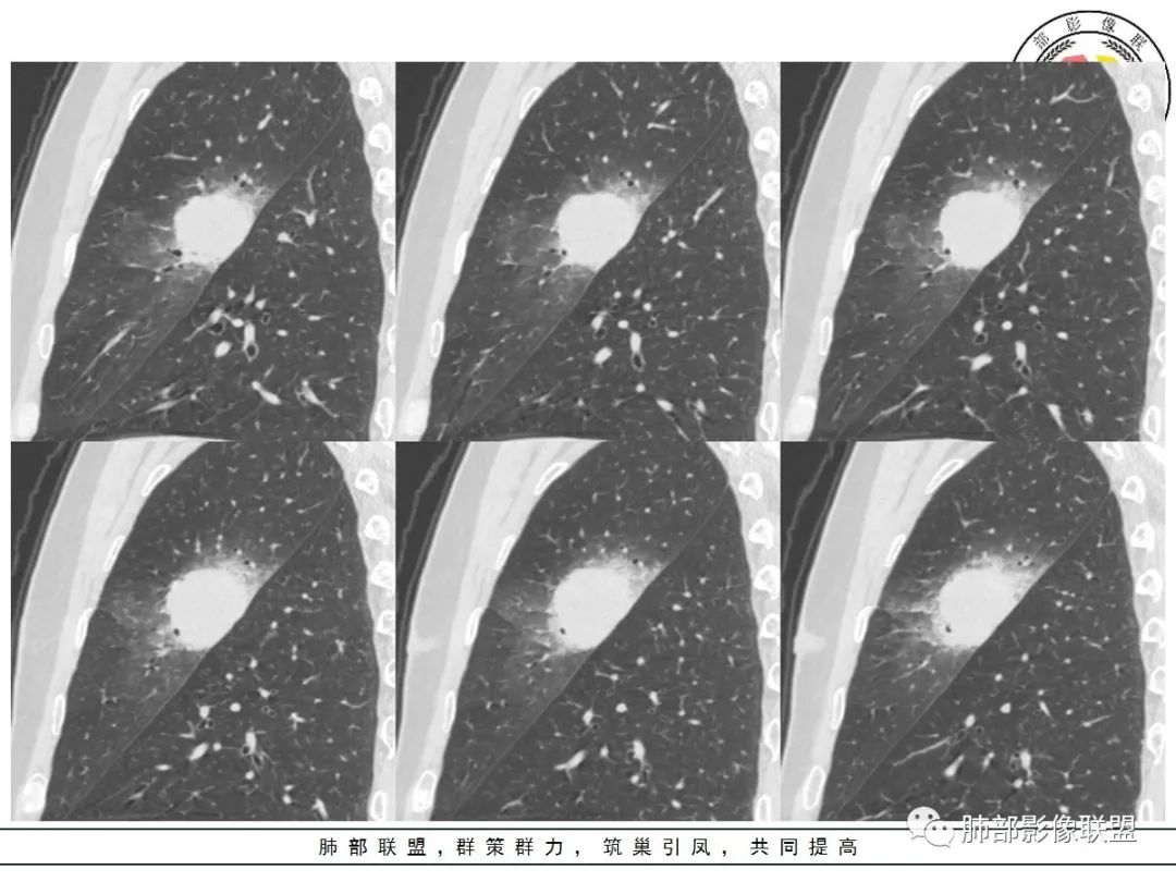 【病例】让人琢磨不透的肺肿块—肺癌1例CT影像 【病例】让人琢磨不透的肺肿块—肺癌1例CT影像