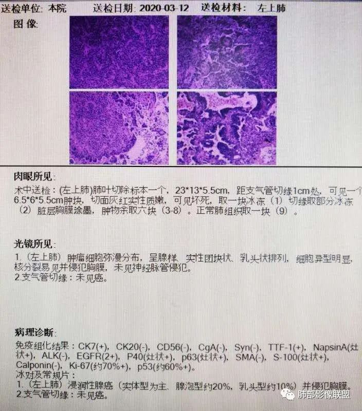 【病例】让人琢磨不透的肺肿块—肺癌1例CT影像
