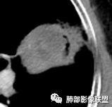 【病例】让人琢磨不透的肺肿块—肺癌1例CT影像