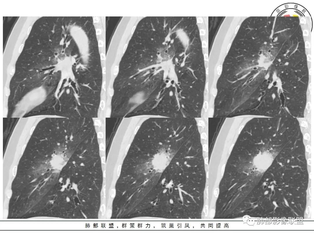 【病例】让人琢磨不透的肺肿块—肺癌1例CT影像