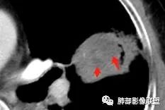 【病例】让人琢磨不透的肺肿块—肺癌1例CT影像