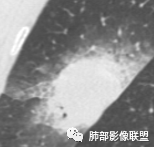 【病例】让人琢磨不透的肺肿块—肺癌1例CT影像