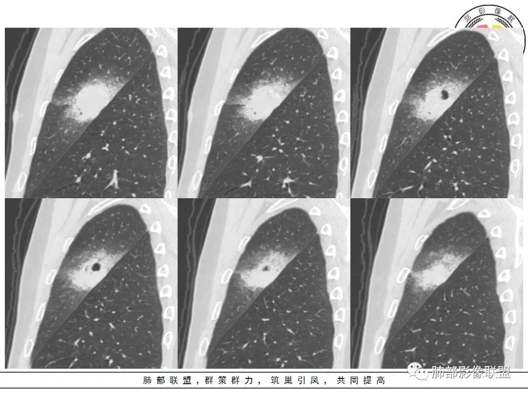 【病例】让人琢磨不透的肺肿块—肺癌1例CT影像