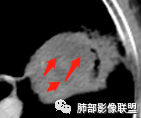 【病例】让人琢磨不透的肺肿块—肺癌1例CT影像