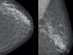 乳腺导管内癌的X线表现