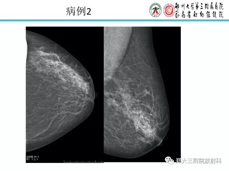 【PPT】乳腺导管内癌的X线表现