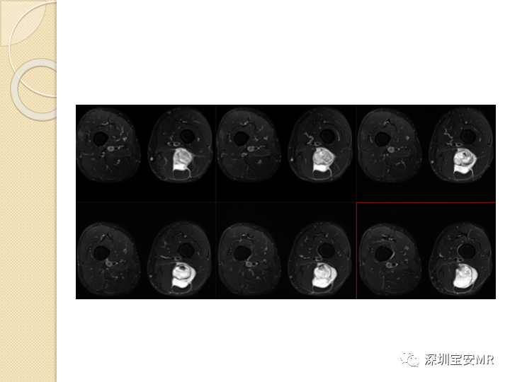 【病例】大腿粘液纤维肉瘤1例MR影像