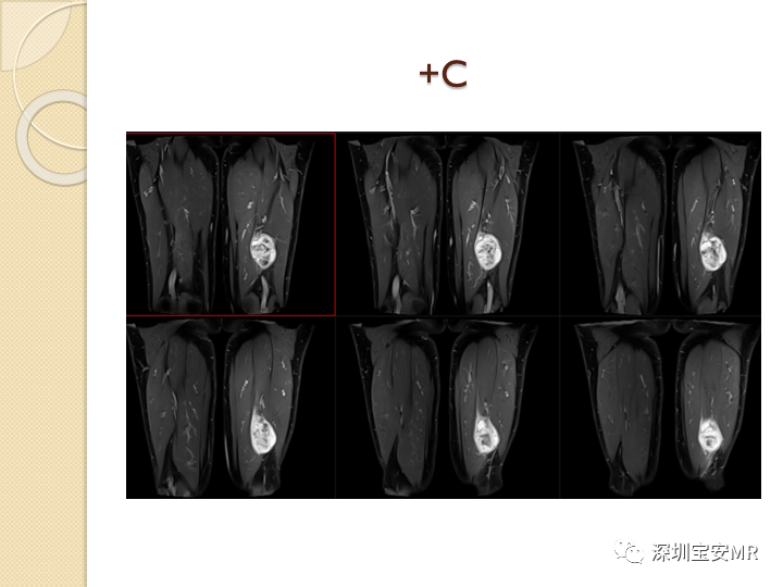 【病例】大腿粘液纤维肉瘤1例MR影像