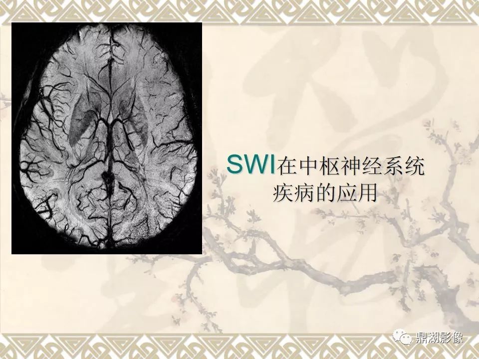 【PPT】SWI（磁敏感加权成像）在中枢神经系统疾病的应用