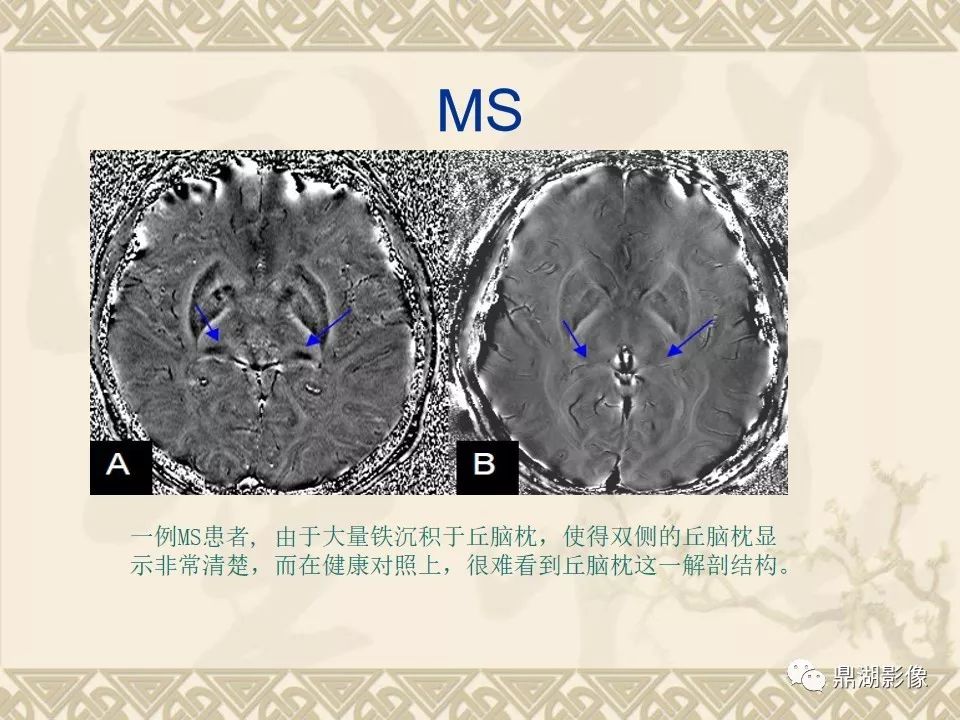 【PPT】SWI（磁敏感加权成像）在中枢神经系统疾病的应用