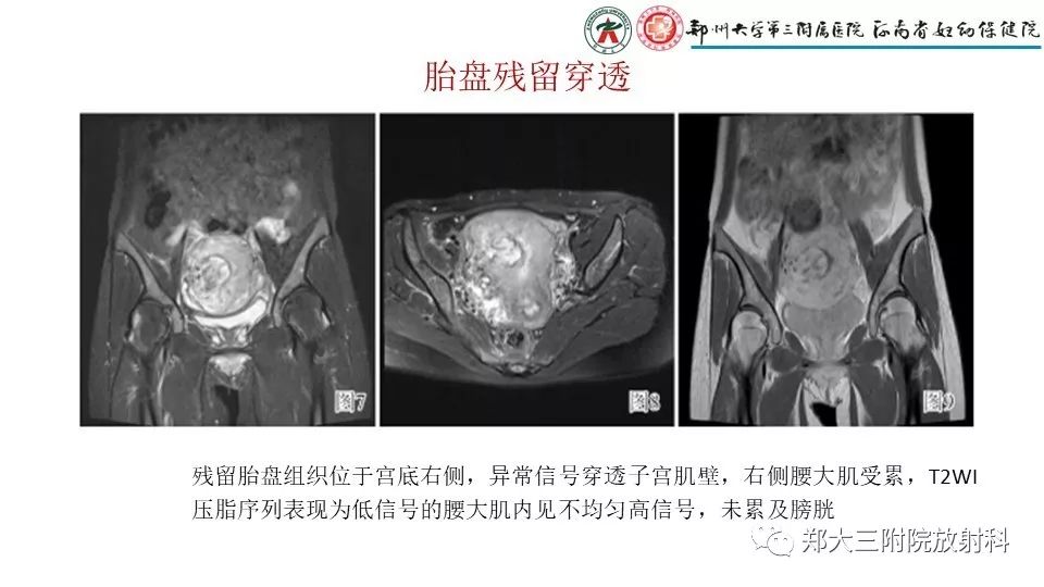 【PPT】产后胎盘残留的影像表现