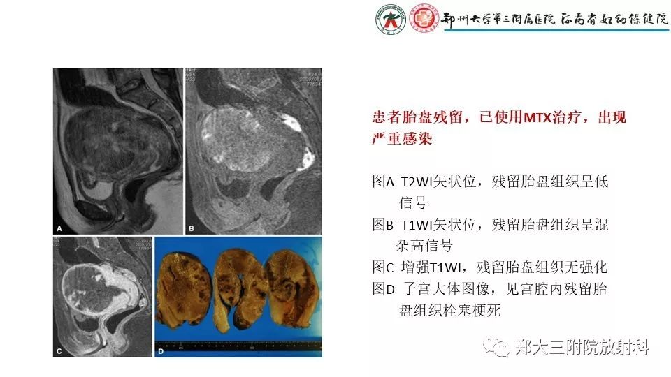 【PPT】产后胎盘残留的影像表现