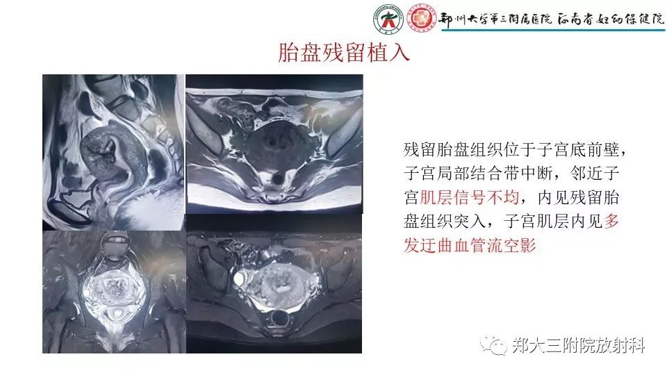 【PPT】产后胎盘残留的影像表现